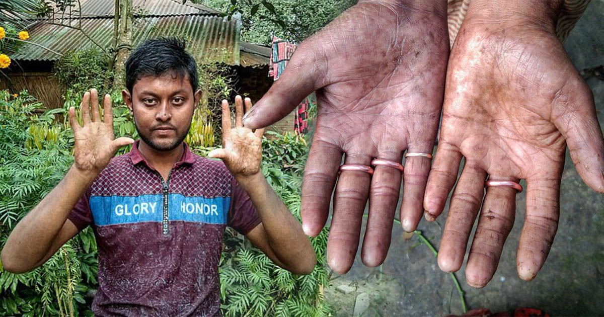 Família do Bangladesh não tem impressões digitais devido a uma mutação genética rara