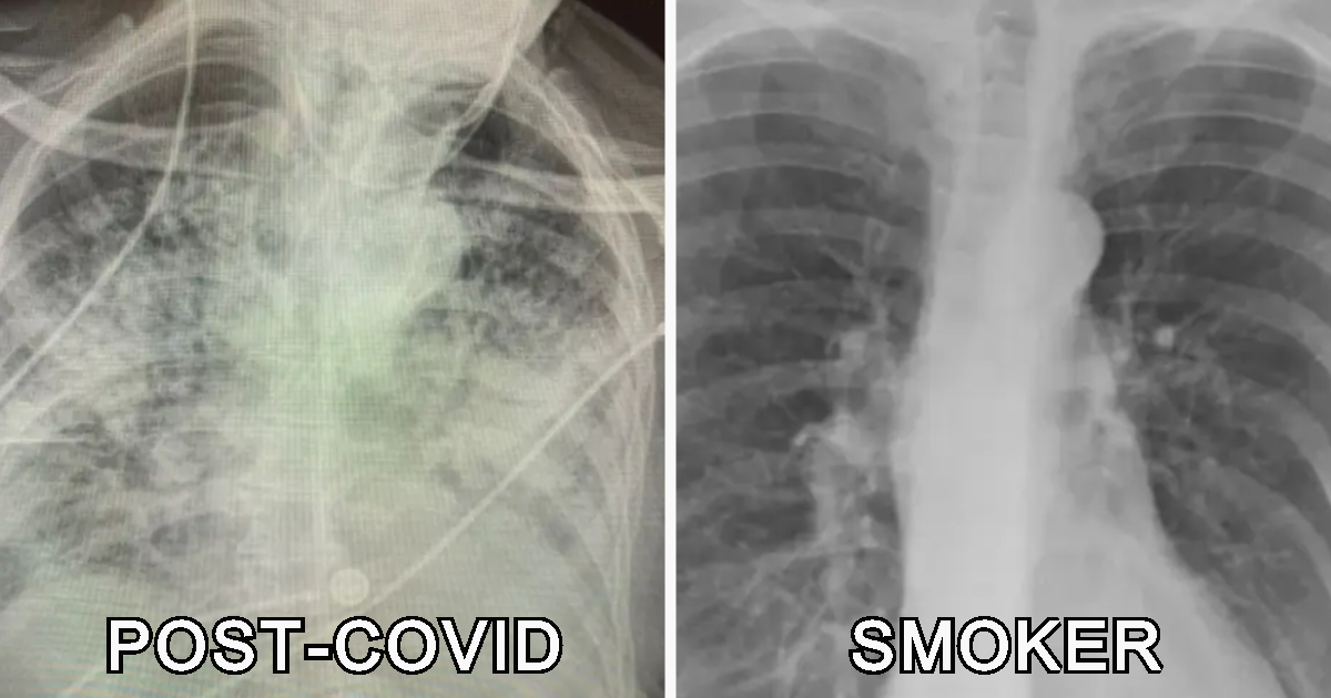 Médica diz que os pulmões pós-COVID têm pior aspeto que os de um fumador