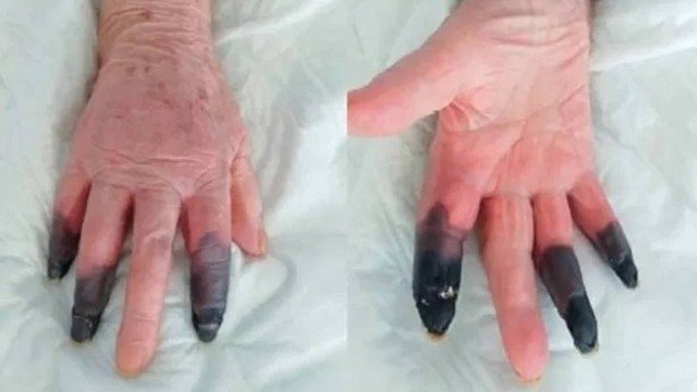 Paciente sofre reacção rara à COVID-19 e acaba com 3 dedos amputados