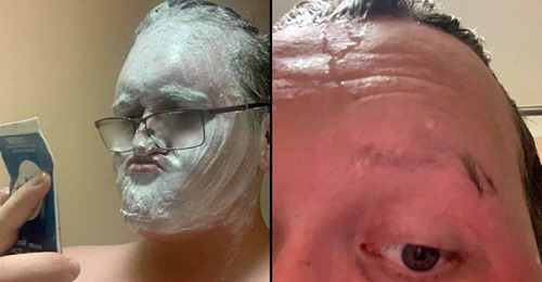 Homem põe creme de depilar na cara toda por engano