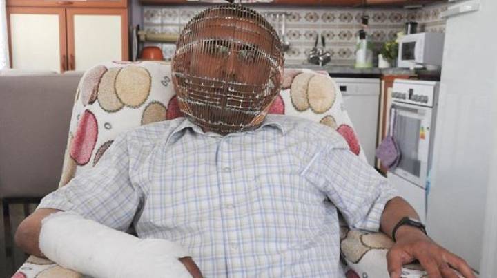 Homem usa uma jaula na cabeça para conseguir parar de fumar
