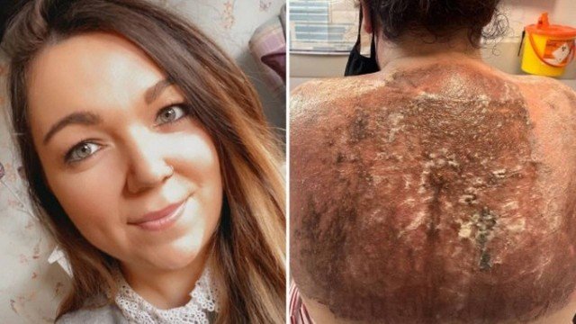 Mulher exibe queimaduras severas nas costas depois de ter ido à praia e de ter "usado protetor solar"