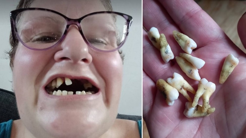 Mulher arranca 11 dentes sozinha por não ter dinheiro para ir ao dentista
