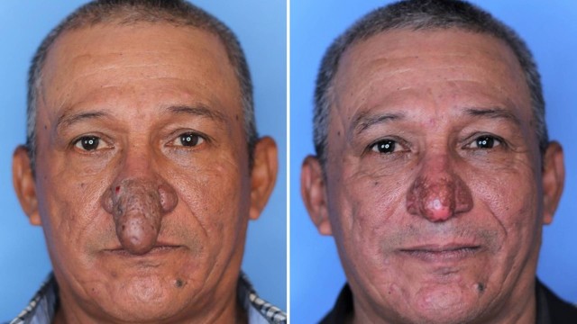 Homem que tinha um nariz em formato de pénis é finalmente operado