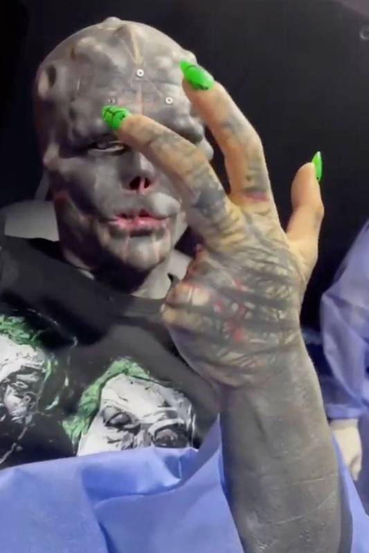 Homem amputa os dedos para ficar mais parecido com um extraterrestre