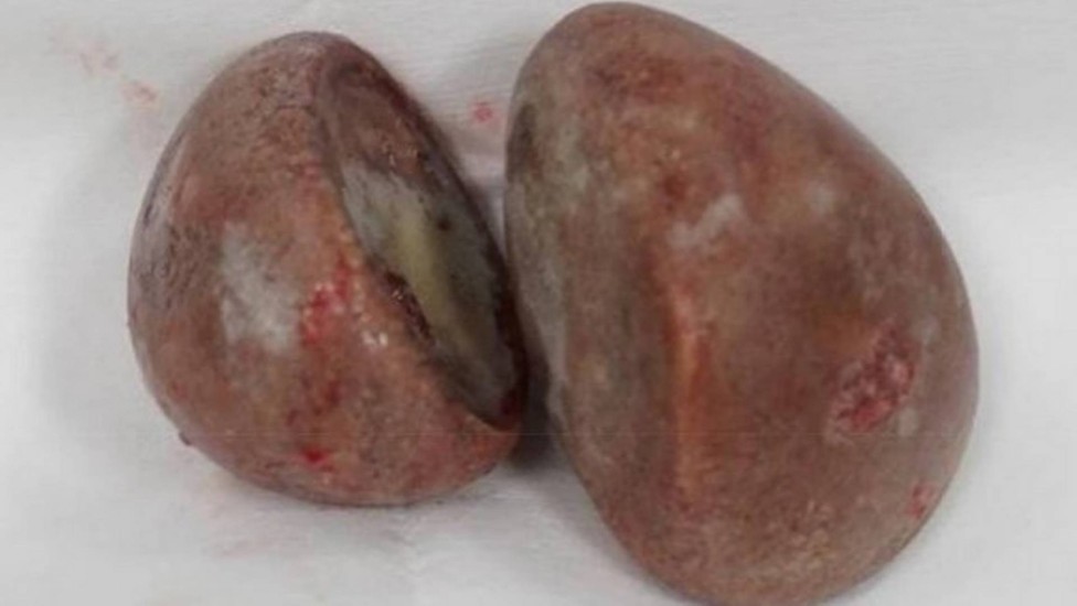 Médicos descobrem pedras enormes na vagina de uma paciente